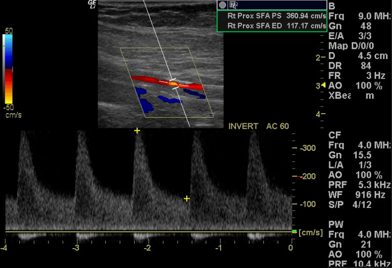 Arterial Duplex Ultrasonography – The Society for Vascular Medicine